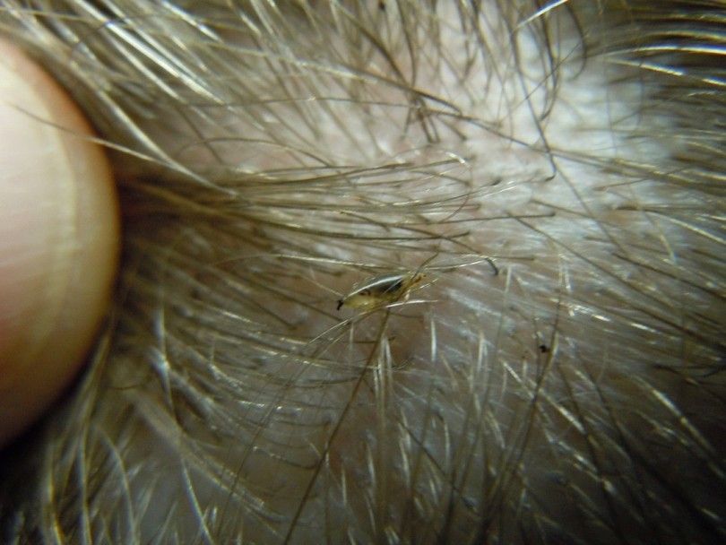 head lice symptoms